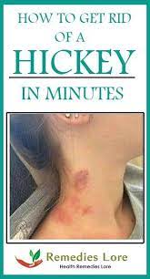 Most of the time people want to get rid of hickey, but if you're trying to have a hickey, there are a few ways to actually create a bruise, or. Pin On Quick Saves