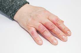 How To Treat A Second-Degree Burn - Amory Urgent Care