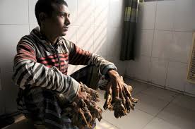 Epidermodysplasia verruciformis (ev), also known as tree man syndrome, is a genetic dermatologic condition. Tree Man Has Surgery What Causes This Rare Condition Live Science
