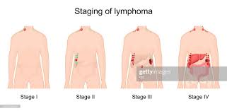 Image result for Lymphoma