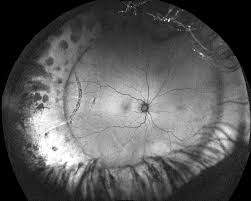 3,4 vitreous hemorrhage is an important sign. Retinal Detachment Recognizing Pathology Optos