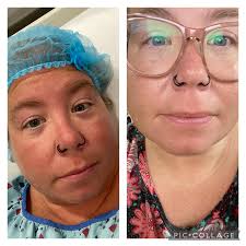 How do bariatric surgery patients know when they are full after surgery?