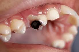 The enamel dissolves, creating a little hole or fissure in your tooth, which is called a cavity. How Deep Is Your Cavity How Much Is Your Tooth Infected