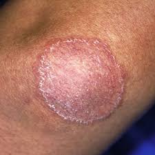 Image result for Eczema nummulare