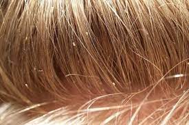 Infestations can spread like wildfire amongst primary school children, so it's vital to check your child's hair not just when you're told about. How To Check For Lice In Blonde Hair Howto Techno