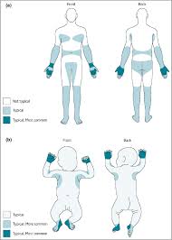 Image result for scabies human children