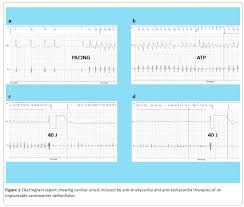 But i am not a cardiologist! Cardiac Arrest Induced By Anti Bradycardia And Anti Tachycardia Therapies Of An Implantable Cardioverter Defibrillator Insight Medical Publishing