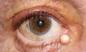 Image result for milium cyst on eyelid