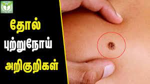 Gastric problem tamil maruthuvam mooligai siddha. Skin Cancer Symptoms Skin Care Tips In Tamil Tamil Health Tips Youtube