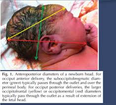Image result for Manual Rotation in Occipitoposterior Presentation