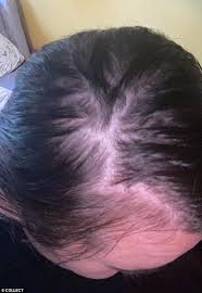 Usually, the bald patches appear suddenly and affect only a limited area. Woman Reveals How She Lost Her Hair Due To Stress And How Jshealth Vitamins Fixed Her Hair Daily Mail Online