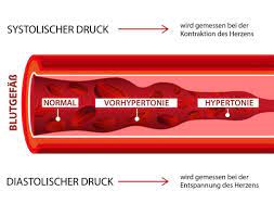 Welche Rolle Spielen Blutdruck Und Puls Beim Herzinfarkt
