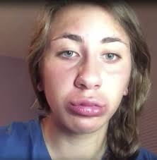 From Kylie Jenner's duck lips to Chrissy Teigen's…