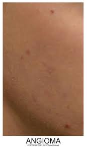 They are clumps of overgrown cells derived from the inside of blood vessels, or vascular endothelium. Treatment Of Cherry Angioma In San Antonio