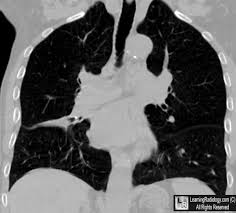 Image result for Broncholithiasis