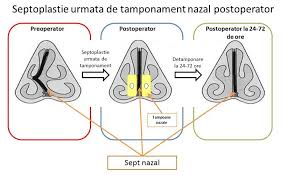 Pentru operatia de deviatie de sept mergeti la dr. Operatia De Deviatie De Sept Nazal Medic Chirurg Orl