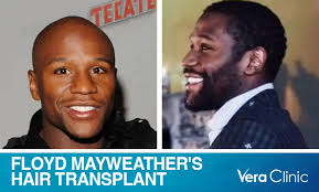 Floyd Mayweather Hair Transplant: Remarkable Journey