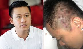 tuan hung mac benh vay nen