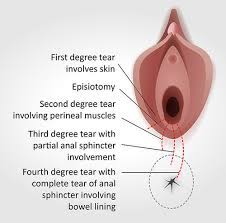 The best treatment would be to use a pad and allow healing to. Perineal Tears During Childbirth