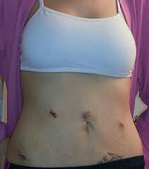 Hysterectomy The Center For Innovative Gyn Care