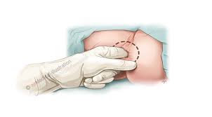 Image result for Pudendal Block