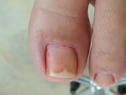 Image result for mykoza nehtů