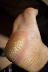 Wir hätten es auch nicht gedacht, aber dieses billige hausmittel bekämpft rissige hornhaut wie kein anderes aus dem drogeriemarkt! Schutzt Dicke Hornhaut Vor Blasen Blasenberatung