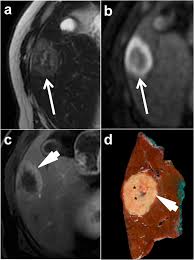 A personal history of colorectal cancer. Colorectal Liver Metastases Radiopathological Correlation Insights Into Imaging Full Text