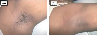 We found that milanlasergreenbay.com is poorly 'socialized' in respect to any social network. Laser Hair Removal A Review Semantic Scholar