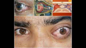 Image result for Proptosis