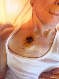 1.5t scanners are the default option. Early Complications After Pacemaker Implantations Intechopen