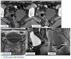 Two frequent types of mesenteric cysts are of lymphatic and. Epos Trade