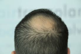 Dieser kaschiert den kopf und lässt den hinterkopf voller aussehen. Ist Durch Eine Haartransplantation Eine Tonsur Behandelbar