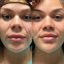 When should I downsize my lip piercing jewelry?