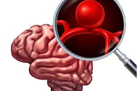 Se o aneurisma acontece num vaso sanguíneo cerebral ele. Aneurisma Cerebral Brasilia Neuro Clinica 61 3297 6992