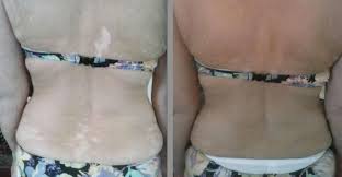 Mit Spray Tanning Gegen Die Weissfleckenkrankheit Mein Studienort Via Medici