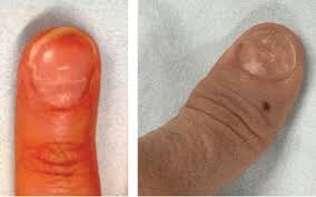 Image result for Beau lines feet