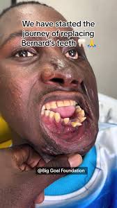 Complete Guide to Replacing Teeth for Better Smiles