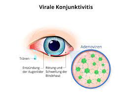 Konjunktivitis ist eine entzündung der augenschleimhaut. Virale Bindehautentzundung Anzeichen Und Behandlung