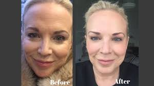 Some practitioners say they inject an average of 10 to 30 units into the forehead. I Had Too Much Botox This New Anti Ageing Treatment Fixed It Healthista