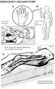 An escharotomy is a surgical procedure performed to allow greater circulation to that part of the body. Roman Breastplate Litfl Clinical Cases Trauma Tribulation