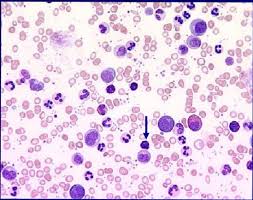 Globulele rosii au coloarea rosu pal, fiind de forma unei gogosi cu o sectiune foarte subtire la mijloc in locul orificiului gogosii. Leucemia Mieloida Granulocitara Cronica Centru Oncologie Severin