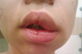 Au moment de prendre votre douche, pensez qu'il faut l'apaiser en plus de vous avez attrapé un vilain coup de soleil ? Urticaire Une Maladie Le Plus Souvent Inflammatoire Pourquoi Docteur