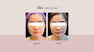 What is the best filler for chin? Here S What It S Like To Get Chin Fillers At Belo Belo Medical Group