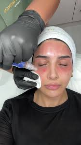 Dura Edith Peeled blastic Face Skin