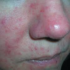 Sun rash and sun allergy are terms often used to describe a number of conditions in which an itchy red rash occurs on skin that's been exposed to sunlight. Worsening Rash On Face Mdedge Family Medicine