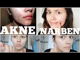 We did not find results for: Unser Narbenpflege Nach Op Blog 2384