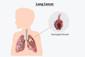 Weight loss with no known cause and loss of appetite. 8 Signs And Symptoms Of Lung Cancer In Children