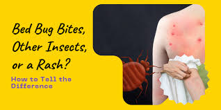 Image result for bedbugs bites