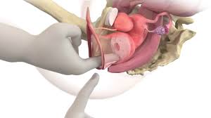 Image result for Pessary